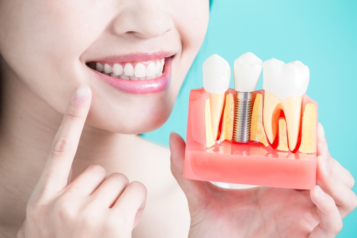 All-on-4 dental implants helping with smile restoration in Brecksville & nearby areas